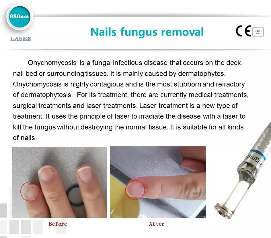 980Nm Laser Diode Vascular Spider Varicose Vein Removal Machine Treatment Fungi Physiotherapy