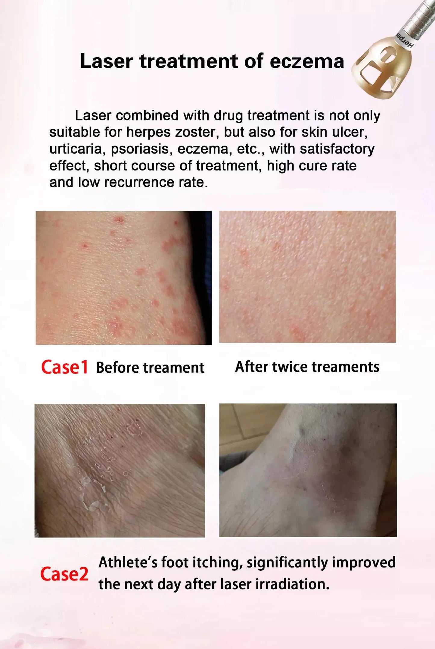 980Nm Laser Diode Vascular Spider Varicose Vein Removal Machine Treatment Fungi Physiotherapy